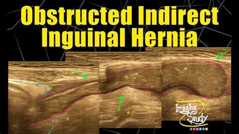 Indirect Inguinal Hernia Ultrasound