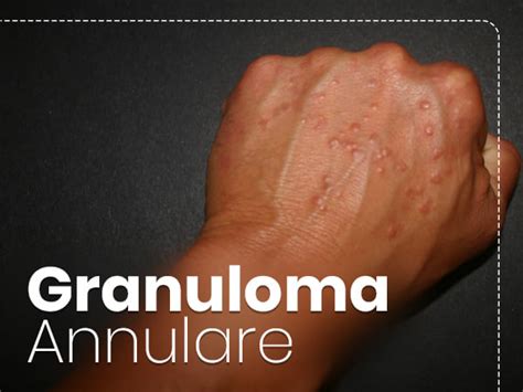 Granuloma Annulare: Types, Causes, Symptoms, Diagnosis And Treatment ...