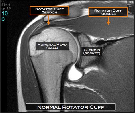 Rotator Cuff Tear Austin, TX | Shoulder Surgery Austin, TX | Shoulder ...