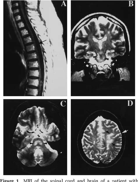 Figure 1 from HTLV-I associated myelopathy/tropical spastic paraparesis ...