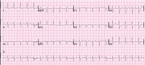 Dr. Smith's ECG Blog: Ventricular fibrillation on a 12-lead ECG