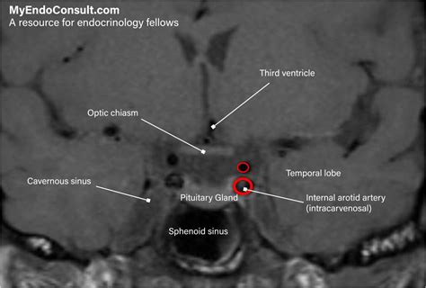 Prolactinoma MRI - My Endo Consult