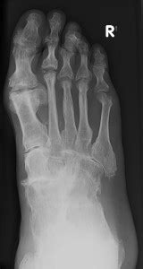 Rheumatoid arthritis foot pain – Podiatrist Brisbane Southside | The ...