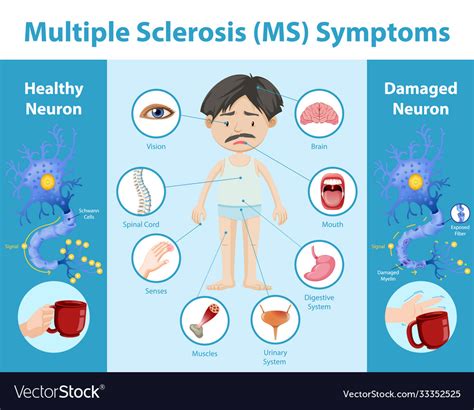 Multiple sclerosis ms symptoms information Vector Image