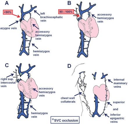 Superior Vena Cava Syndrome in Thoracic Malignancies | Respiratory Care