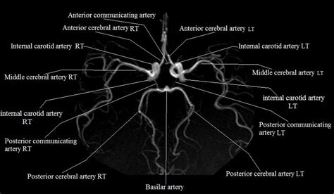 Radiology Anatomy Images : Anterior communicating artery Anterior ...