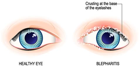 What is Blepharitis? – You & Eye by Dr. Nicky