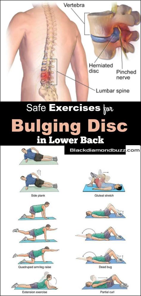 Workout For Herniated Disc | EOUA Blog