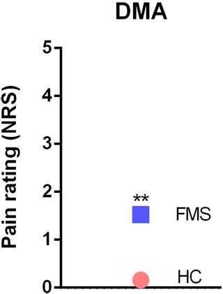 Fibromyalgia-associated hyperalgesia is related to psychopathological ...