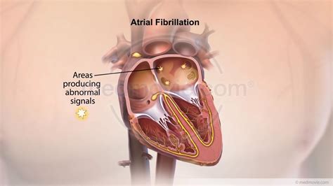 Atrial Fibrillation – Medmovie.com