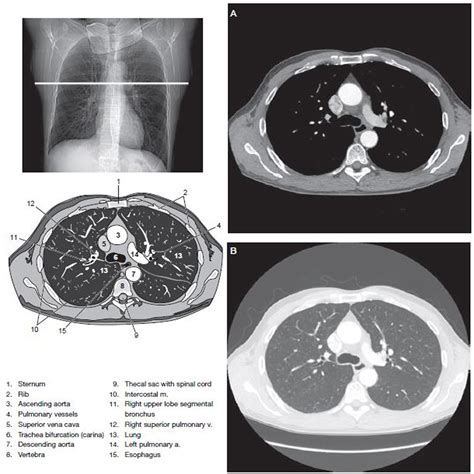 Chest CT Scan Imaging - RadTechOnDuty