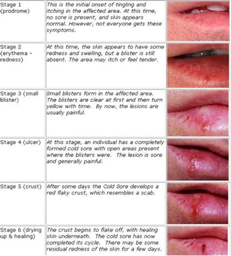 Herpes symptoms pictures-What does a herpe sore look like