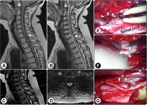 Herniated Disc Thoracic Mri