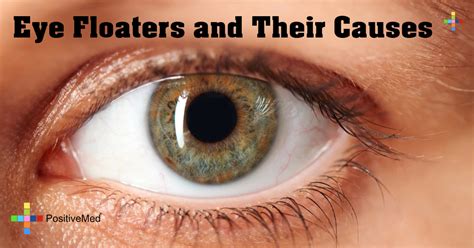 83-Eye-Floaters-and-Their-Causes - PositiveMed