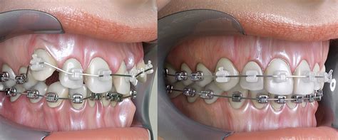 Straightening Your Teeth: A Comprehensive Guide