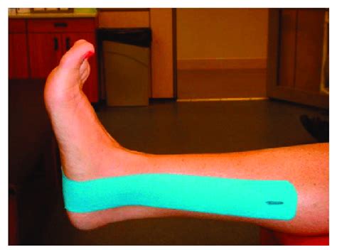 Medial view of the first strip of Kinesio tape. | Download Scientific ...