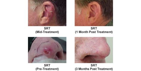 Superficial Radiation Therapy (SRT) - Mid-Atlantic Skin Surgery Institute