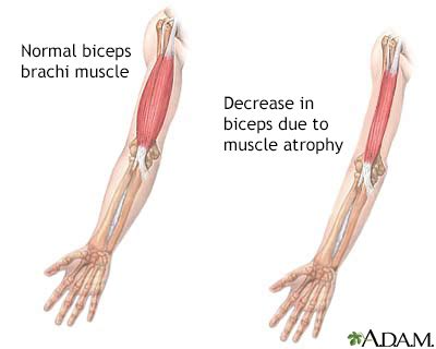 Muscle atrophy Information | Mount Sinai - New York