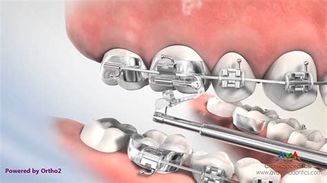 Overjet (AKA Overbite) Treatment by Esprit - Orthodontic Device - YouTube