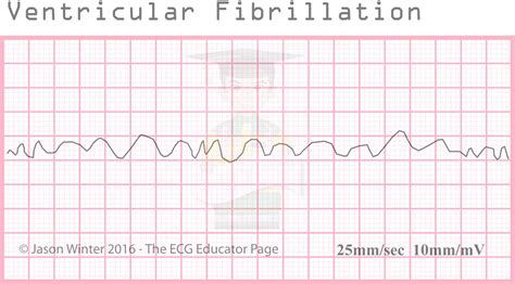 ECG Educator Blog : Ventricular Rhythms