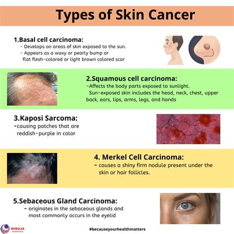 Types of Skin Cancer