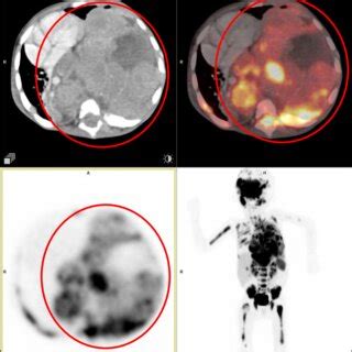 Type A thymoma. Anterior mediastinal mass that was pathologically ...