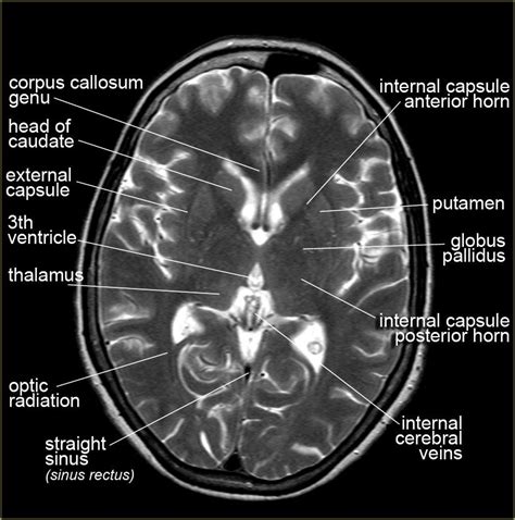 Brain Anatomy | Brain anatomy, Mri brain, Brain anatomy and function