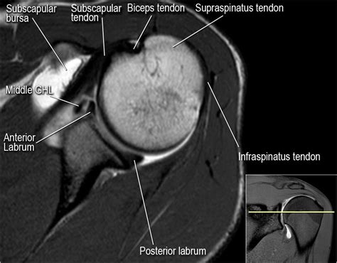 Glenohumeral Ligament Mri