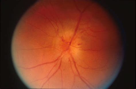 Used to Describe Edema of the Optic Nerve