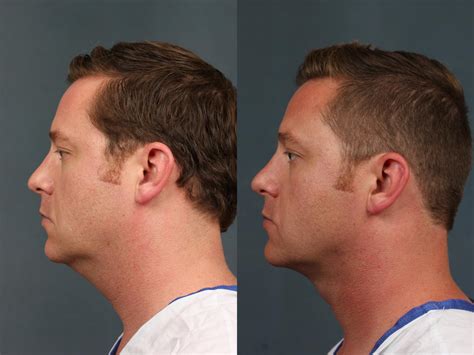 Neck Procedures Before & After Photo Gallery | Louisville, KY | CaloSpa ...