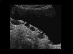 Urinary Tract and male reproductive system | 2.2 Bladder : Case 2.2.3 ...