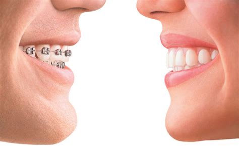 Orthodontics Australia | What is an ideal bite?