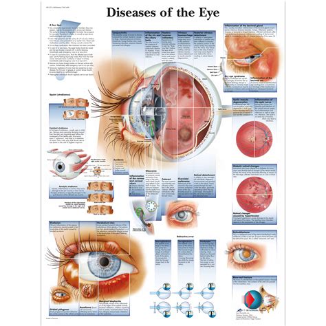 Diseases of the Eye Chart - 4006666 - 3B Scientific - VR1231UU ...