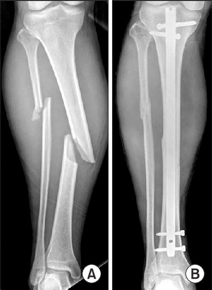 Tibia And Fibula Fracture Surgery