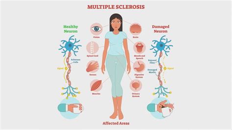 Multiple Sclerosis - Symptoms & 4 Ultimate Causes