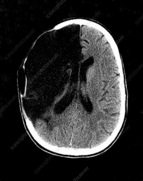 Brain Stroke, CT Scan - Stock Image - C027/2376 - Science Photo Library