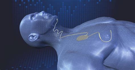 Sleep apnea patient finds rest with implant device: "It saved my life ...