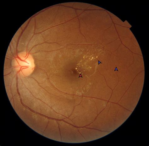 Mild non-proliferative diabetic retinopathy with clinically significant ...