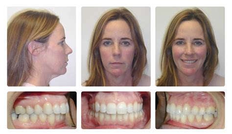 Orthodontic Before and After Photos | Brodsky Orthodontics