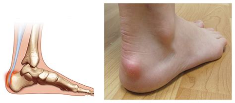 Achilles Bursitis Retrocalcaneal Bursitis Symptoms, Causes Treatment ...