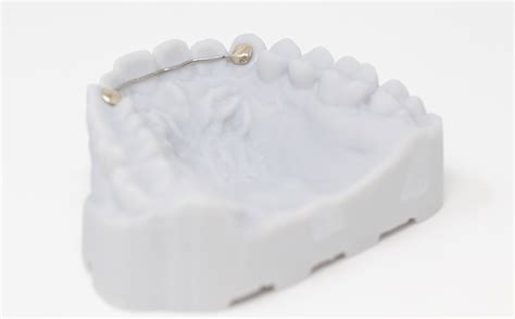 Lingual Retainer RDL | Russellville Dental Lab