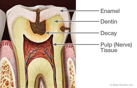 Tooth Pain | Dental Innovations | Mark D. Shirley, DDS | Oklahoma City ...