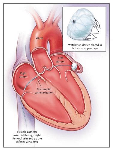 Left Atrial Appendage Occlusion — Closure or Just the Beginning? | NEJM