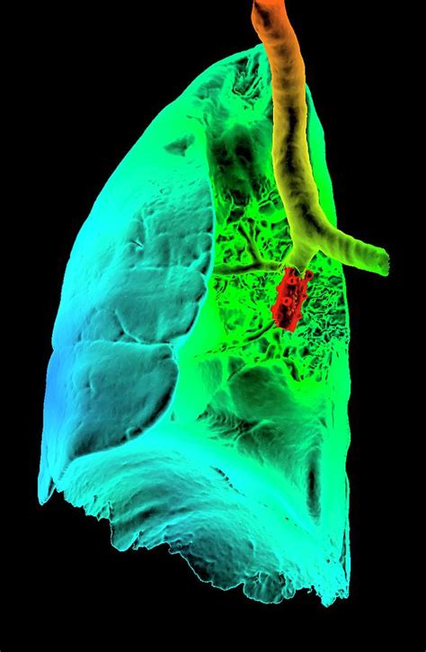 Bronchial Stent Photograph by K H Fung/science Photo Library - Fine Art ...