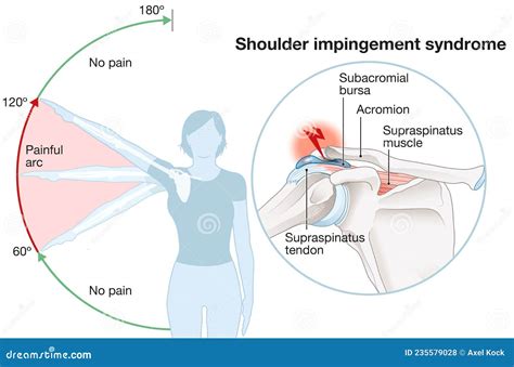 Shoulder Impingement. Painful Arc. Labeled Illustration Stock ...