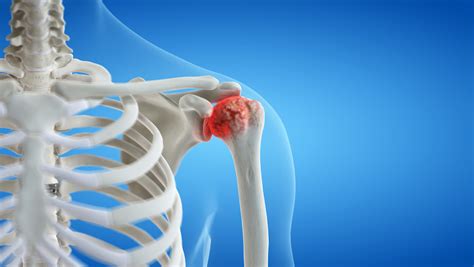 Shoulder Arthritis Surgery