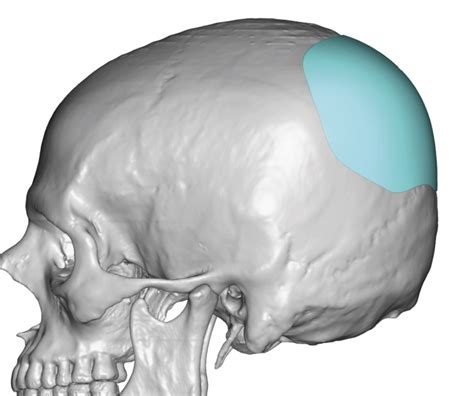 Plastic Surgery Case Study - Custom Skull Implant for Male Residual ...