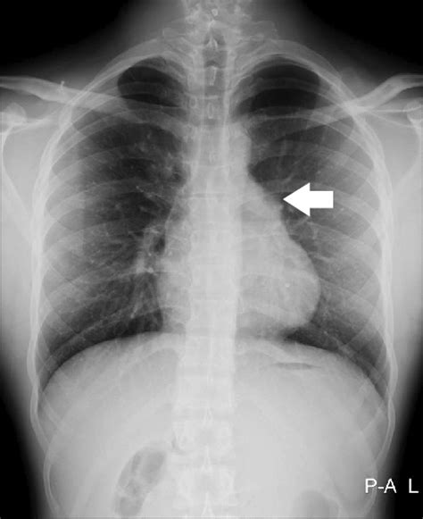 Preoperative chest radiography shows enlarged left atrial appendage ...