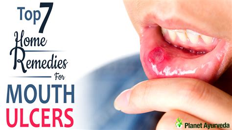 Top 7 Home Remedies for Mouth Ulcers: