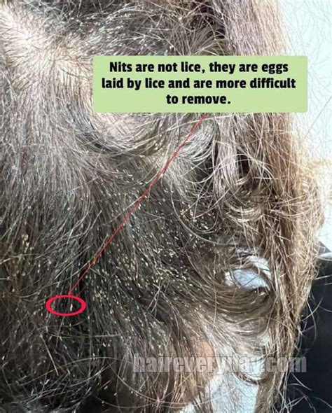 How To Remove Nits From Hair Without A Comb | Permanent And Painless ...